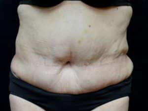 Body Contouring After Weight Loss Surgery