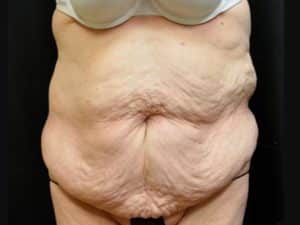 Before Image: Body Contouring After Weight Loss Surgery