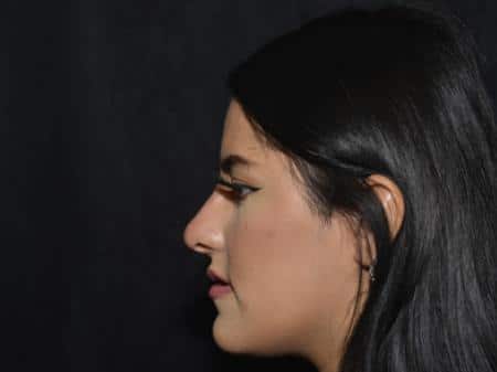 After Image: Filler Injection - left-side
