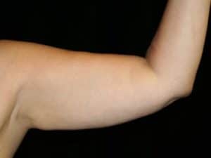 Before Image: Arm Lift
