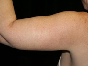 After Image: Arm Lift