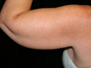 Before Image: Arm Lift