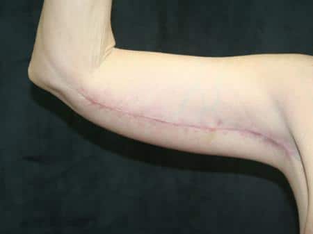 After Image: Arm Lift - front