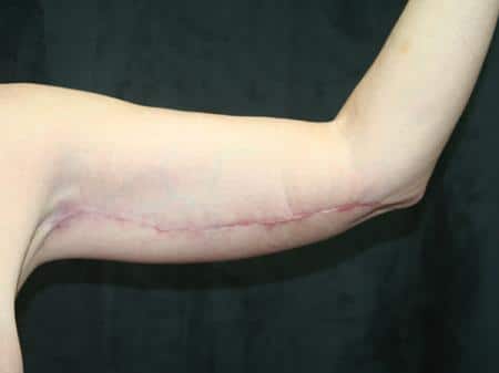 After Image: Arm Lift - front