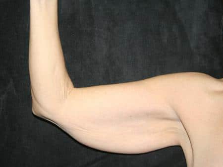 Before Image: Arm Lift - front