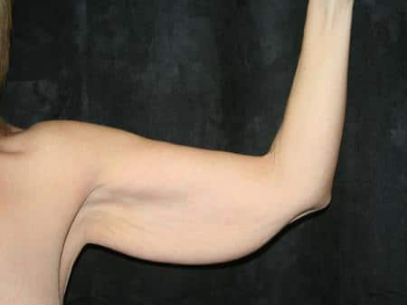Before Image: Arm Lift - front