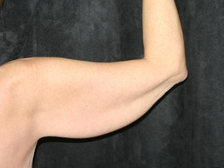 Before Image: Arm Lift - back