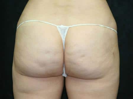 After Image: Buttock Reshaping - back