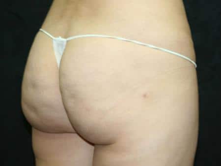 After Image: Buttock Reshaping - right-back-oblique