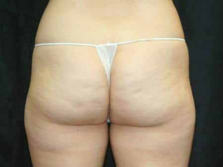 Before Image: Buttock Reshaping - back