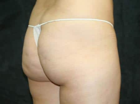 Before Image: Buttock Reshaping - right-back-oblique