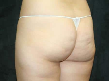 Before Image: Buttock Reshaping - left-back-oblique