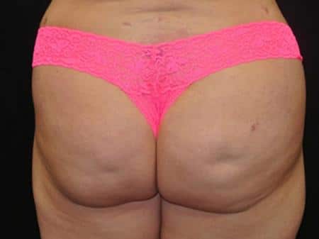 After Image: Buttock Reshaping - back