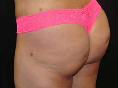 After Image: Buttock Reshaping - left-back-oblique