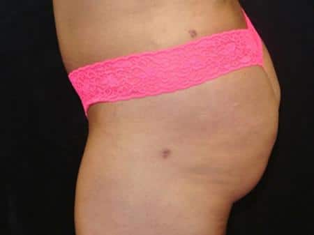 After Image: Buttock Reshaping - left-side
