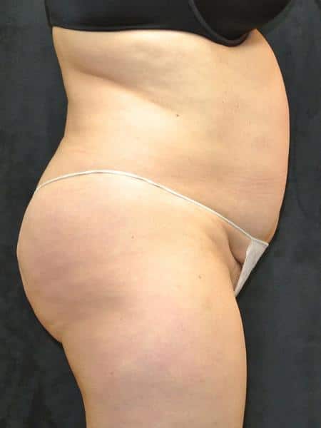 Before Image: Buttock Reshaping - right-side