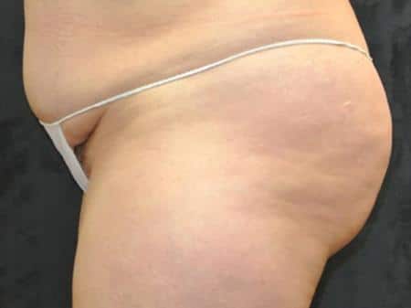 Before Image: Buttock Reshaping - left-side