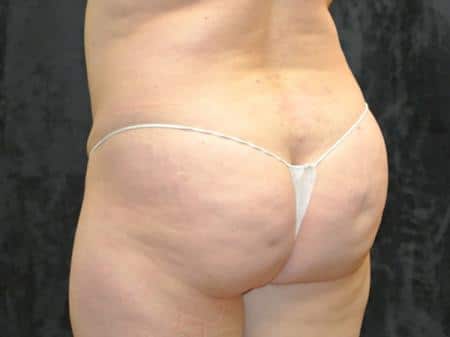 Before Image: Buttock Reshaping - left-back-oblique