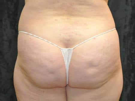 Before Image: Buttock Reshaping - back