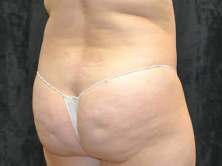 Before Image: Buttock Reshaping - right-back-oblique