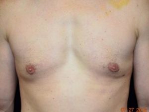 After Image: Male Breast Surgery