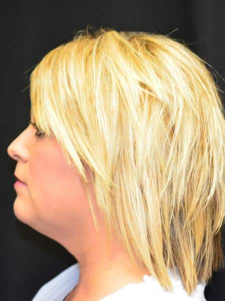 Before Image: Liposuction - left-side