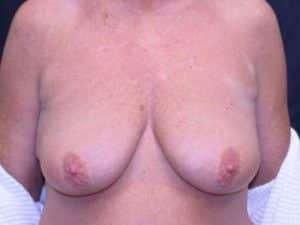 Breast Lift