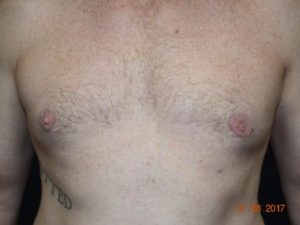 After Image: Male Breast Surgery