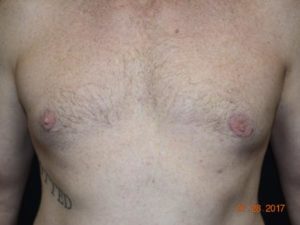 Male Breast Surgery