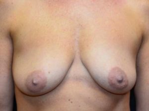 Breast Lift