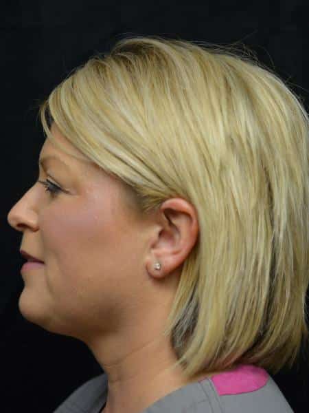 After Image: Liposuction - left-side