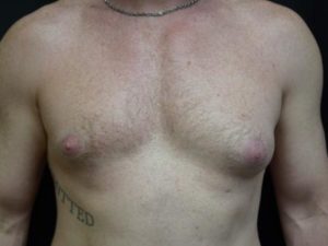 Before Image: Male Breast Surgery