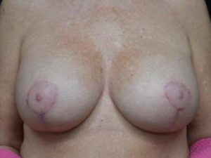 Breast Lift