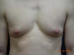 Male Breast Surgery