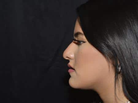 Before Image: Filler Injection - left-side