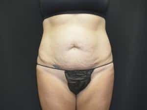 Tummy Tuck