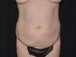 Tummy Tuck