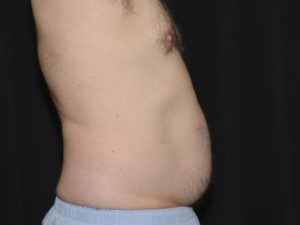 Before Image: Liposuction