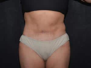 Tummy Tuck