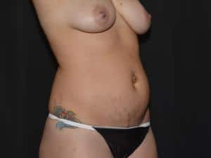 Tummy Tuck