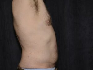 After Image: Liposuction