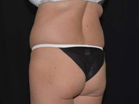 Buttock Reshaping