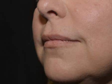 Before Image: Filler Injection - left-front-oblique
