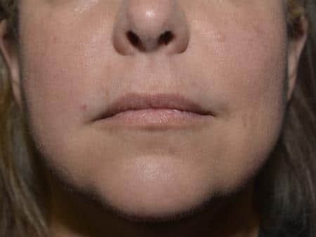 Before Image: Filler Injection - front