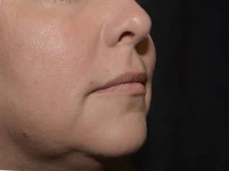 Before Image: Filler Injection - right-front-oblique
