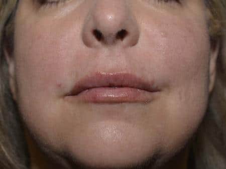 After Image: Filler Injection - front