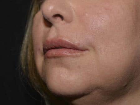 After Image: Filler Injection - left-front-oblique