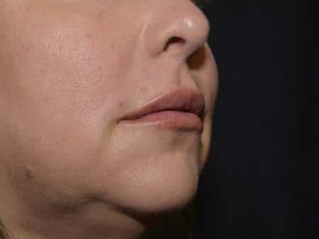 After Image: Filler Injection - right-front-oblique