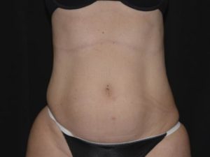 Liposuction