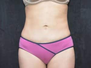 Tummy Tuck